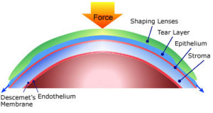 Orthokeratology-shaping-lens