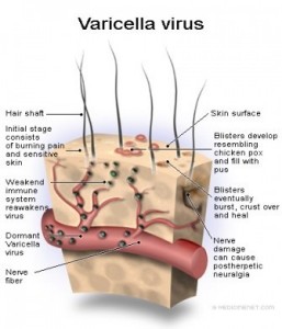 varicella-bambini-virus